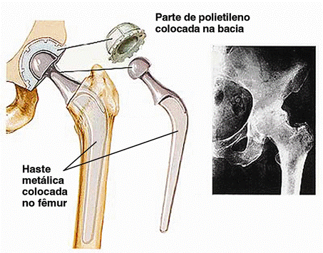 Cirurgia de Quadril - Ceo Ortopedia - Centro de Especialidades Ortopédicas  | Porto Alegre